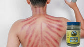 Scraping the Wind Coining Gua Sha Massage Therapy in Laos